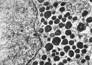 M, 23y. | acidophilic pituitary adenoma (STH)